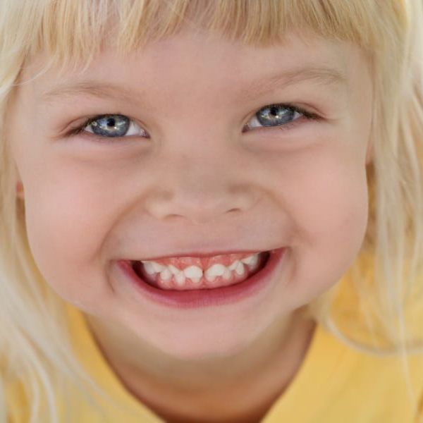 Ortodoncia Interceptiva en niños